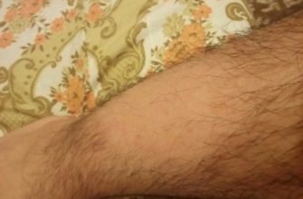 Выпадение волос на ногах_