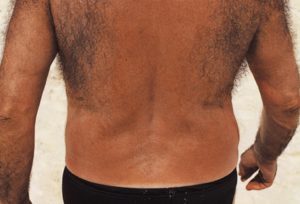 Гипертрихоз