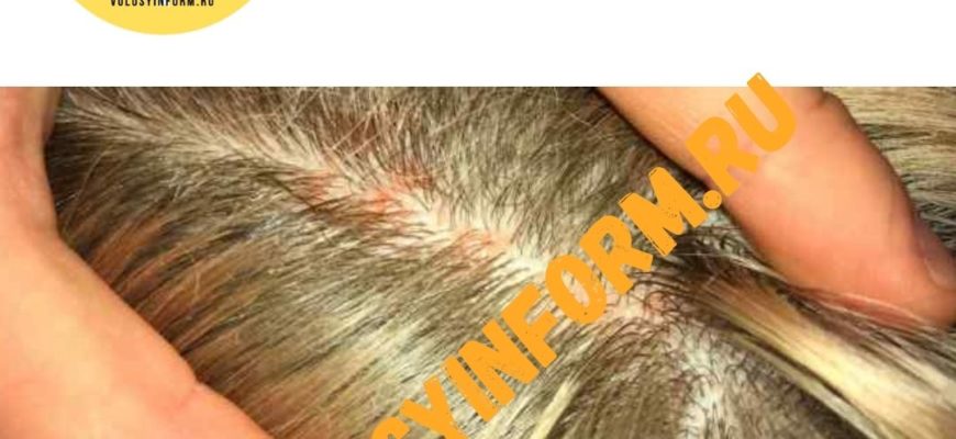 Струпья на коже головы