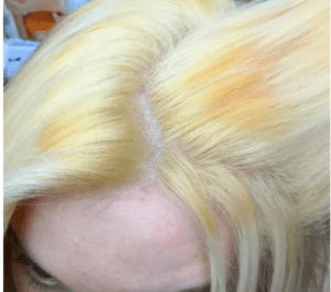 Отбеливатель способен открывать кутикулу волоса и растворять меланин волоса